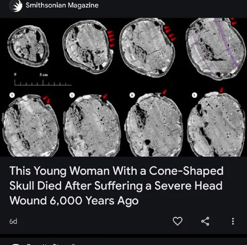 6000-Year-Old Head Injury