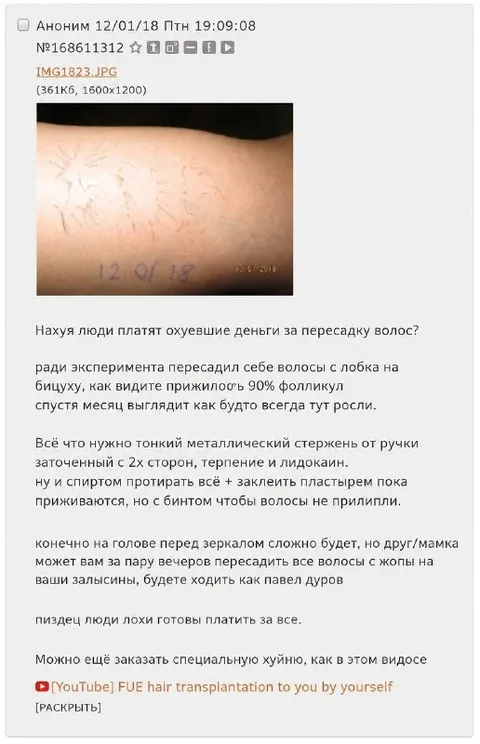 Самостоятельная пересадка волос