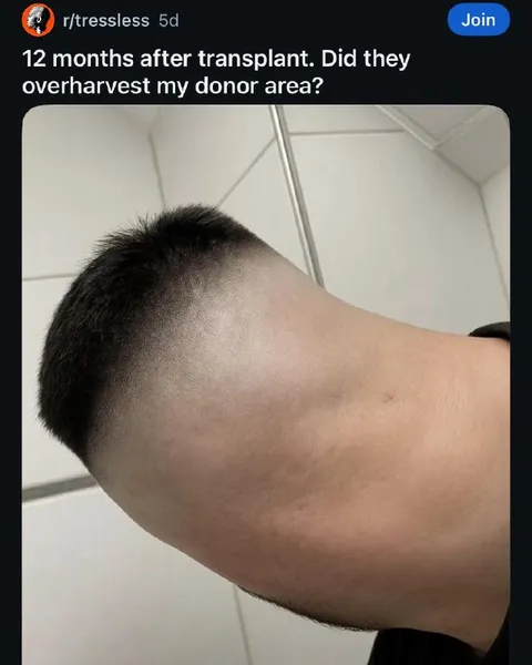 Overharvested Donor Area