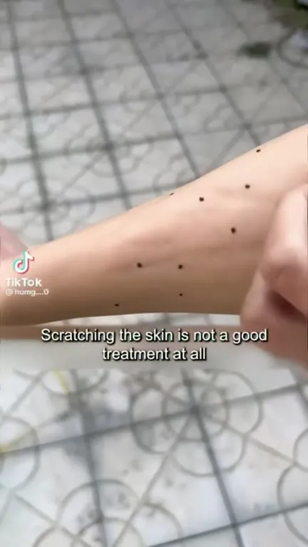The Itch Removal Machine