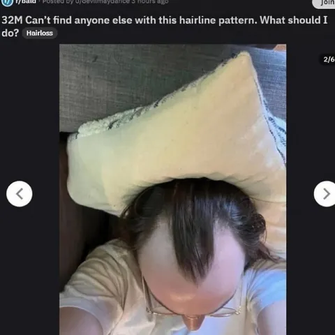 Can't Find This Hairline Pattern