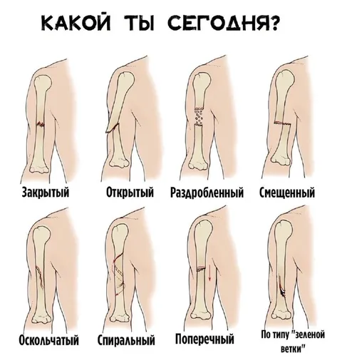 Какой ты сегодня перелом?