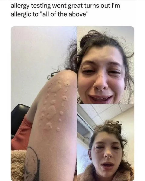 Allergic to All of the Above