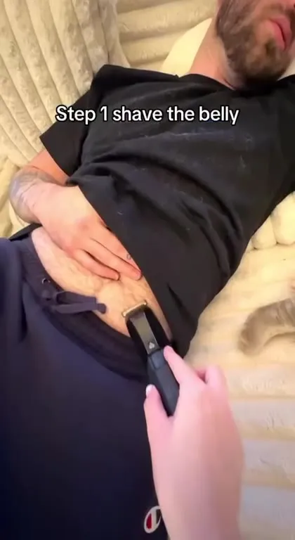 DIY Hair Transplant Gone Wrong