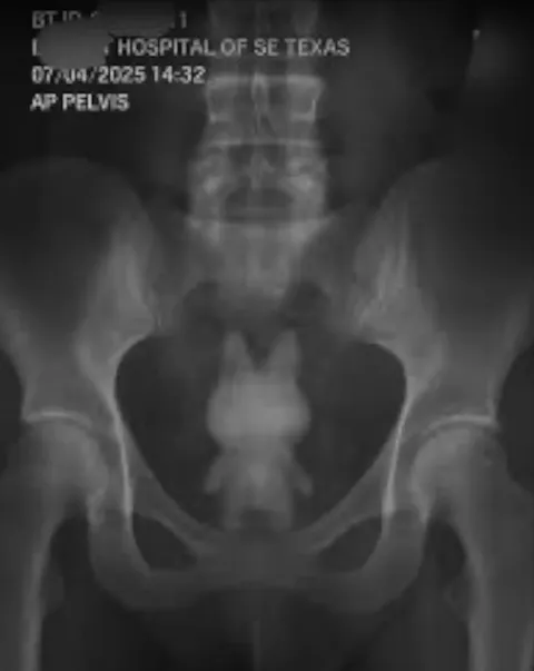 Pelvis X-Ray With a Surprise