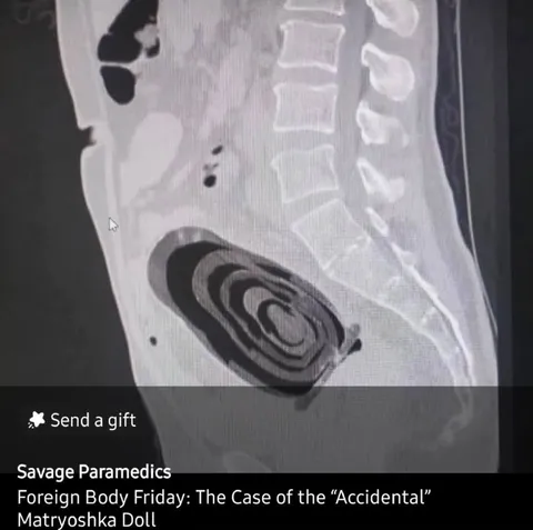 Accidental Matryoshka Doll X-Ray