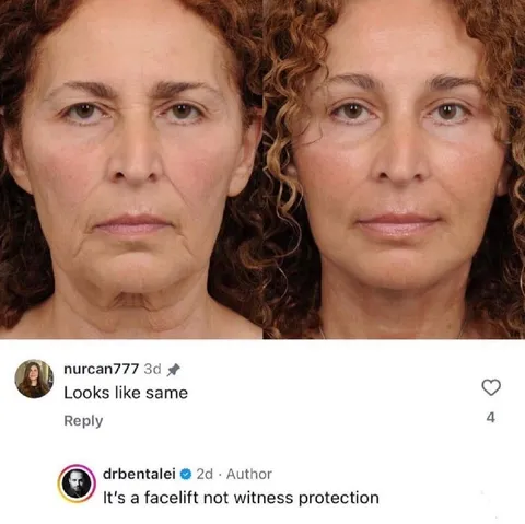 Facelift Not Witness Protection