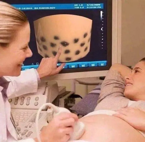 Baby Bubble Tea Ultrasound