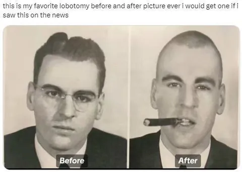 Favorite Lobotomy Before and After