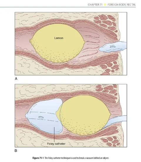 Lemon Stuck in the Rectum