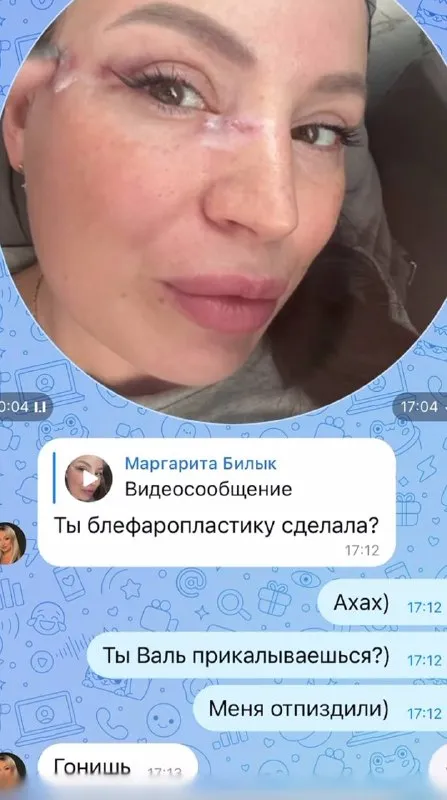 Меня отпиздили после блефаропластики