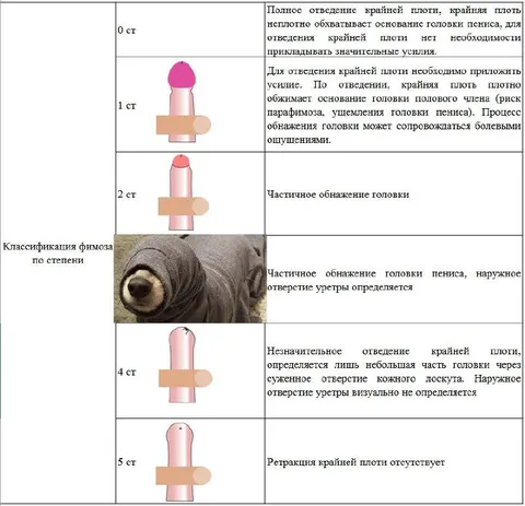 Классификация фимоза по степени