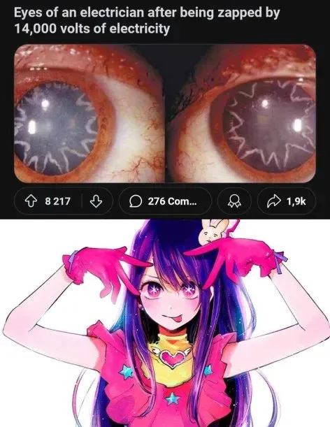 Electrician Eyes After 14000 Volts