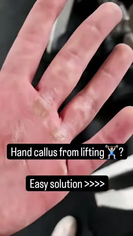 Easy Solution for Lifting Calluses