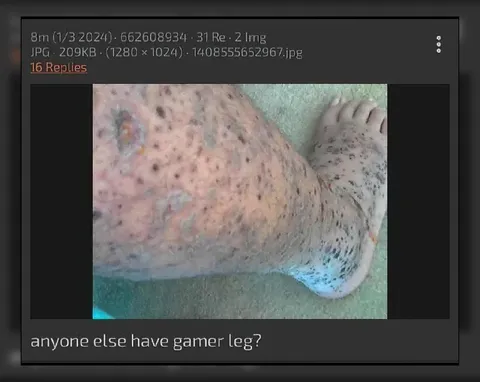 Anyone Else Have Gamer Leg?