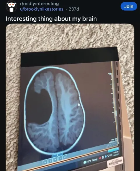 Interesting Thing About My Brain