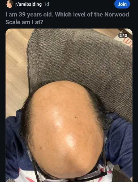 Norwood Scale Hair Loss Question