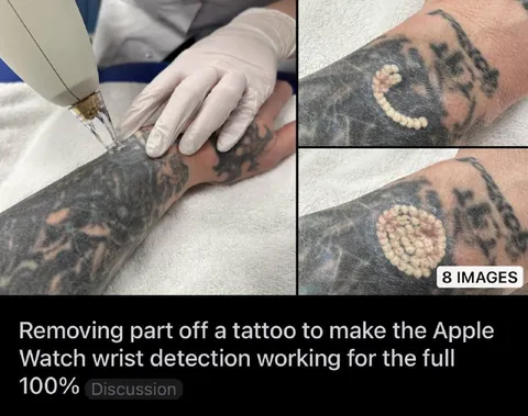 Apple Watch Tattoo Removal