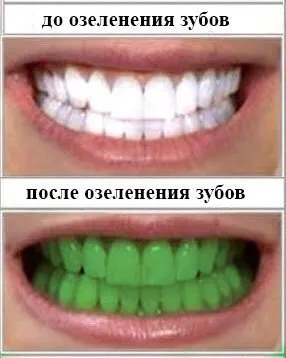 Озеленение зубов вместо отбеливания