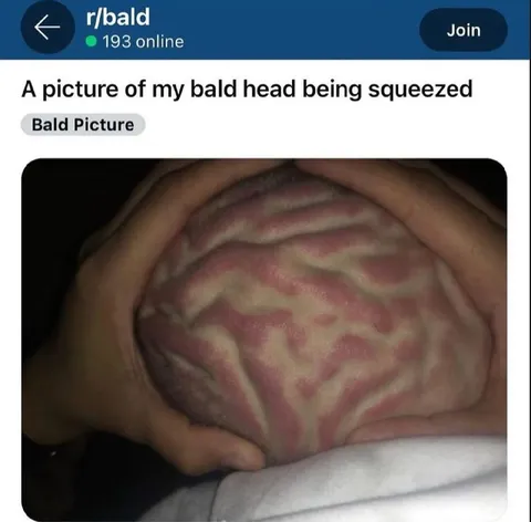 Bald Head Being Squeezed