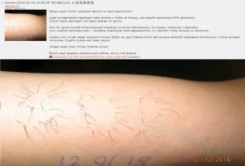 Пересадка волос с лобка на бицуху