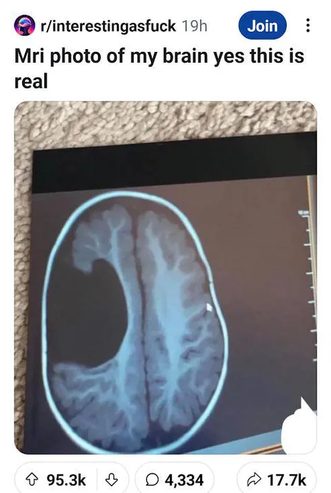 MRI Photo of My Brain