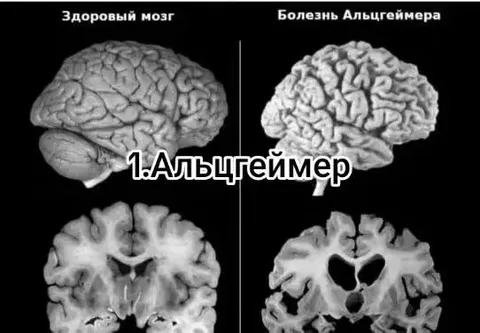Здоровый мозг и болезнь Альцгеймера