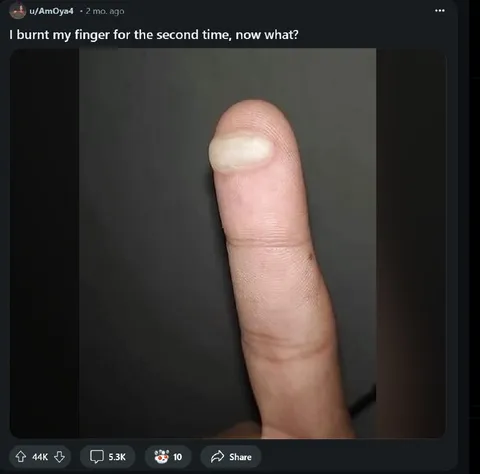 Burnt Finger Again