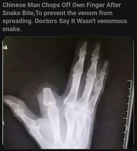 Chinese Man Cuts Off Finger