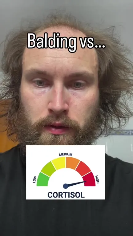 Balding Versus Bald