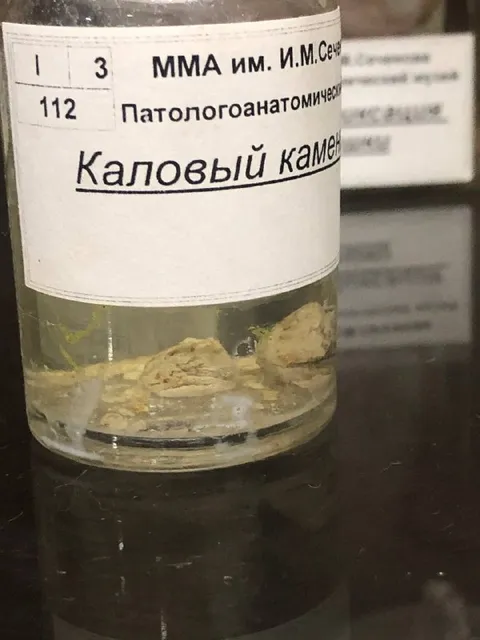 Каловый камень в банке