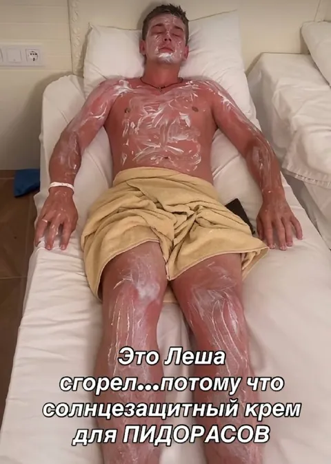 Леша сгорел из-за крема