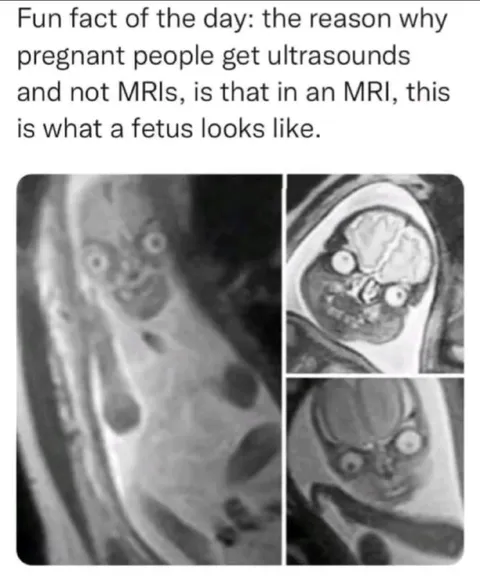 MRI Fetus Looks Terrifying