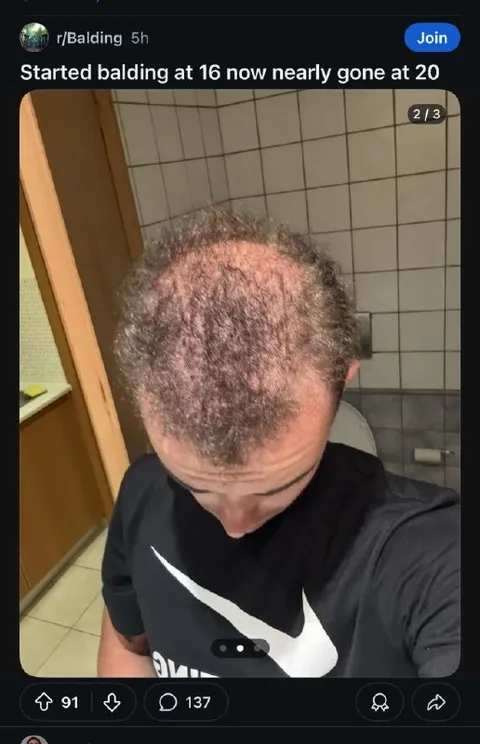 Started Balding at 16