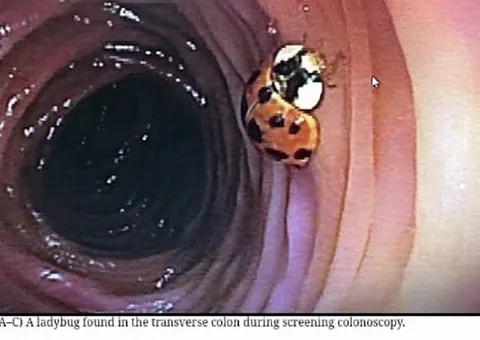 Ladybug in the Colon