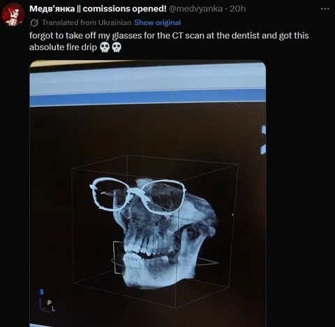 Glasses in a Dental CT Scan