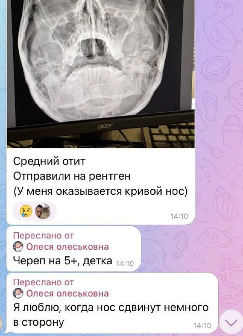 Кривой нос на рентгене