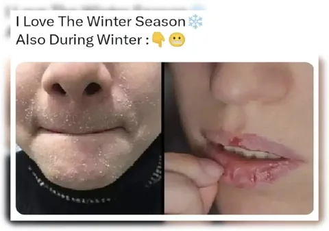 I Love Winter, But Winter Hurts