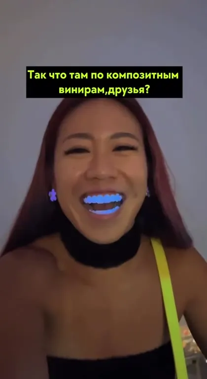 Композитные виниры и Shooting Stars