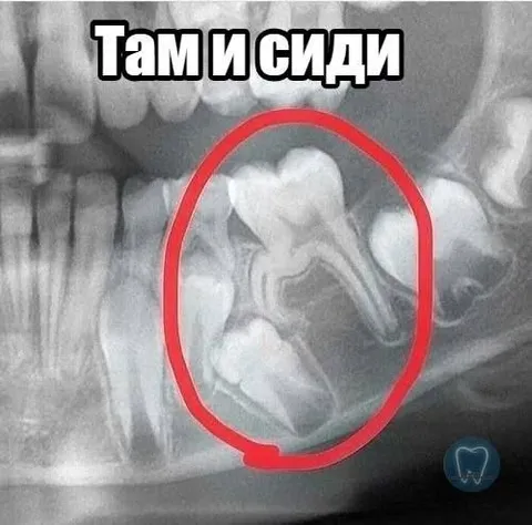 Там и сиди — зуб мудрости