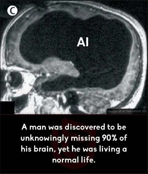 Missing 90% of His Brain