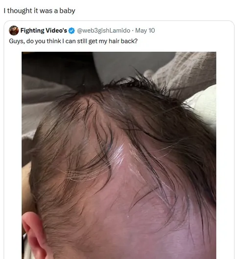 Baby With Receding Hairline