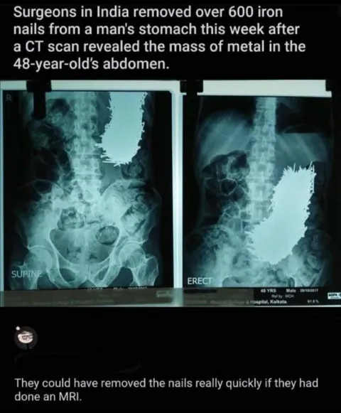 Iron Nails MRI Joke