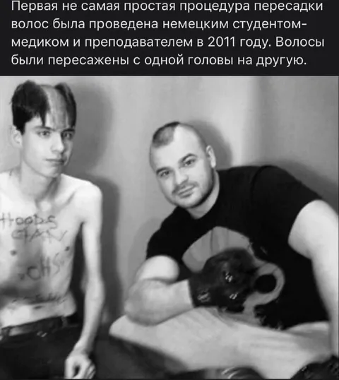Пересадка волос с одной головы на другую
