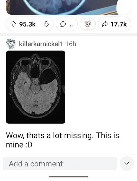 A Lot Missing From My Brain