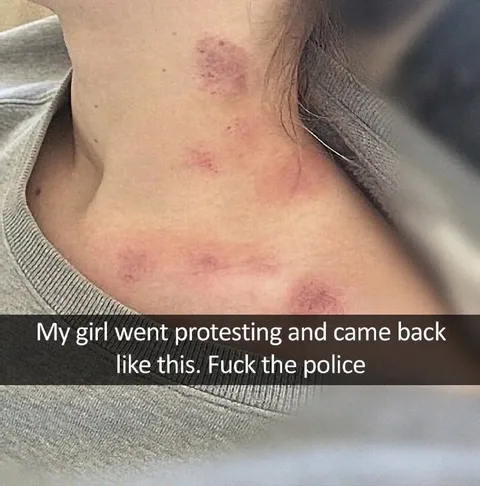 Protesting Girlfriend Came Back Bruised