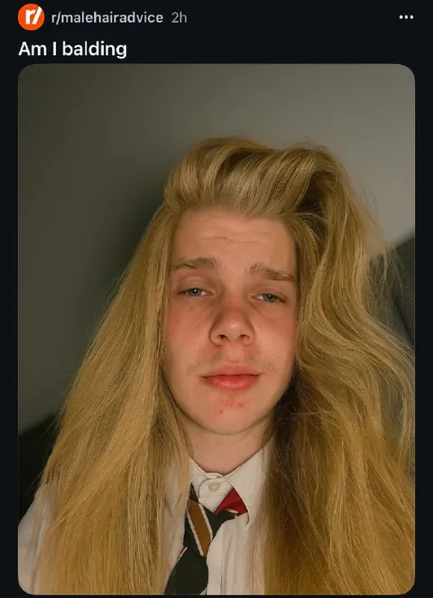 Am I Balding with Long Hair