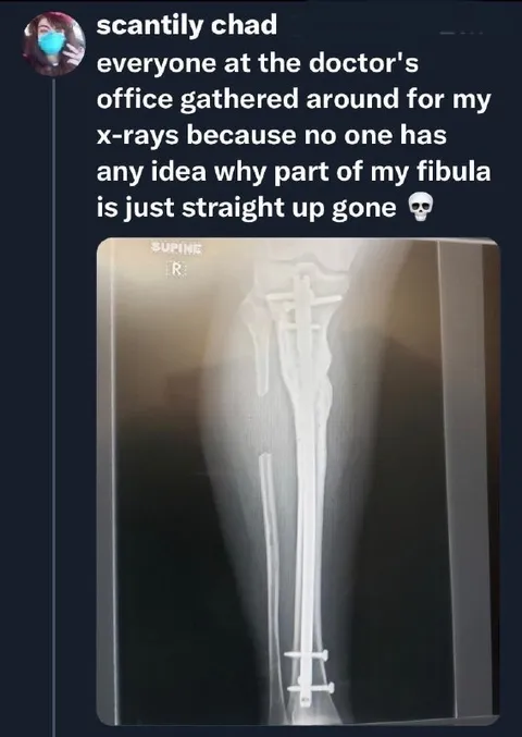 Mysteriously Missing Fibula