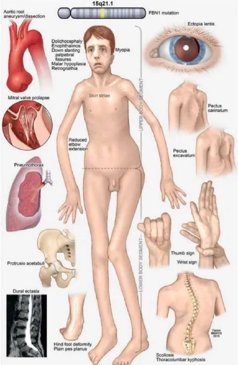 Marfan Syndrome Clinical Features