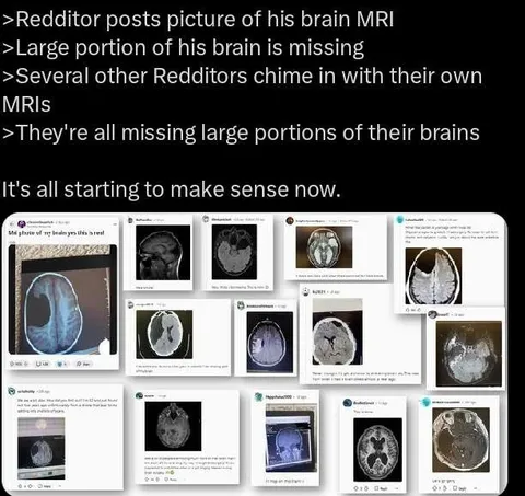 Redditors Missing Brain Portions